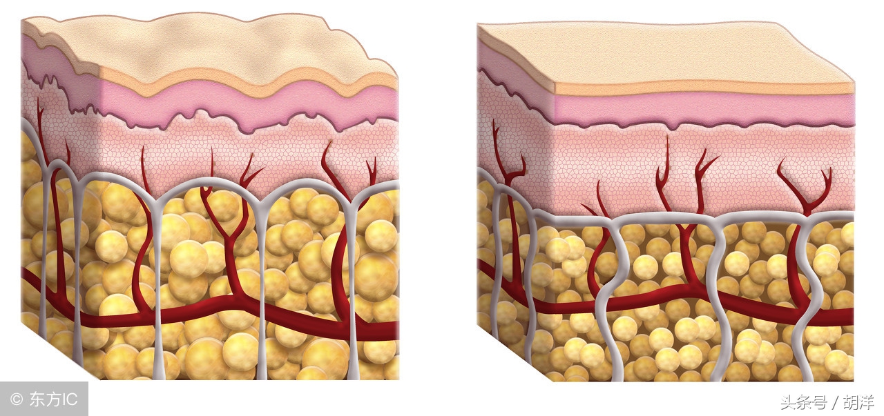 大脑脂肪瘤会变成恶性肿瘤吗,肾上腺髓质脂肪瘤是恶性肿瘤吗