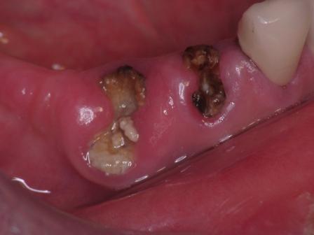 不能随便拔牙的原因,不能拔牙但是牙坏了怎么办