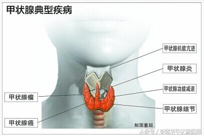 甲状腺结节属于甲亢还是甲减,甲状腺结节是甲亢还是甲减造成的