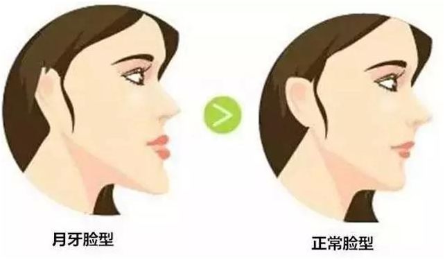 歪瓜裂枣好不好,歪瓜裂枣的牙齿好矫正吗