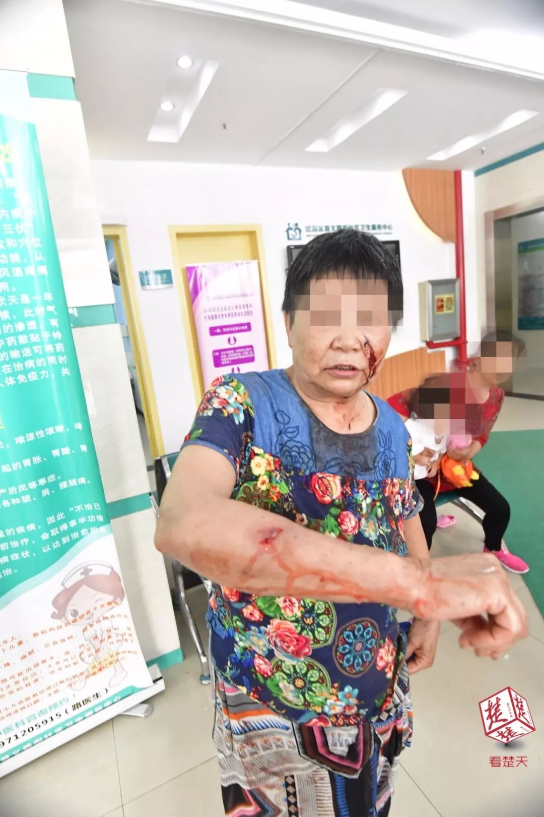 可怕！半岁宝宝被大狗叼走，头骨被咬穿，需做开颅手术！避免被狗咬应该这么做……