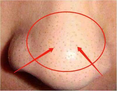 怎么才能完美的遮住鼻子上的黑头,鼻头黑头怎么去除草莓鼻