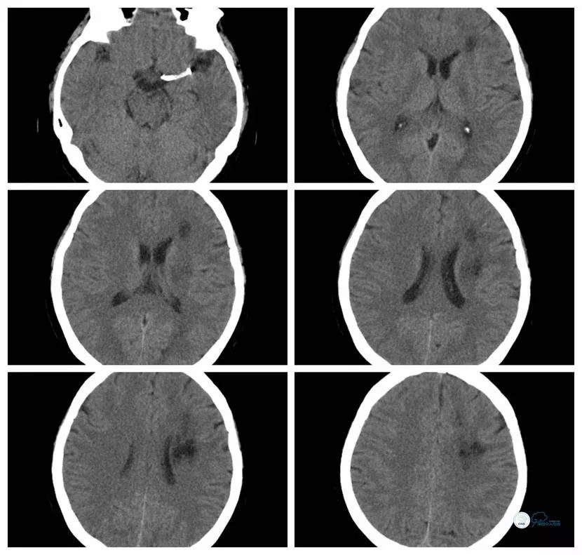 大脑中动脉支架术后再狭窄的几率,天坛医院介入脑血管手术