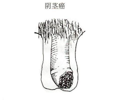 阴茎癌得病几率大吗,阴茎癌手术是切阴茎吗