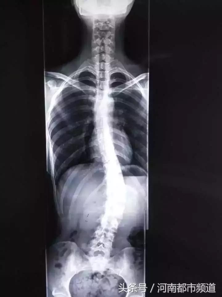 19岁女孩拍x光医生一句话引热议,3岁照x光