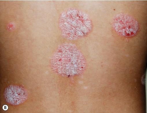 银屑病是什么样的病症,银屑病是免疫系统疾病