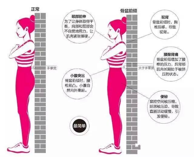 调整骨盆前倾的动作,骨盆前倾的手法复位