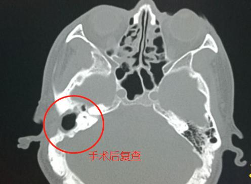 孩子听力下降的最佳恢复方法,鼻窦炎引起中耳炎听力下降怎么治