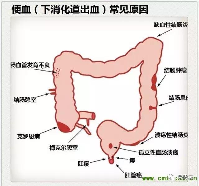 下消化道出血便血,下消化道出血一般什么原因
