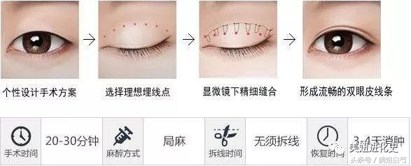 双眼皮埋线的亲身经历,对要做双眼皮埋线的几个建议