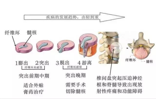 腰突出压迫神经腿痛如何康复锻炼,腰突压迫腿麻康复锻炼操