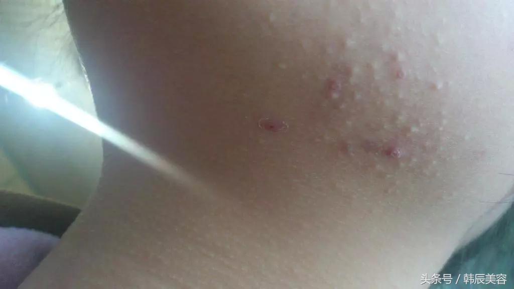 防止脸上长粉刺的方法,脸上长斑要当心