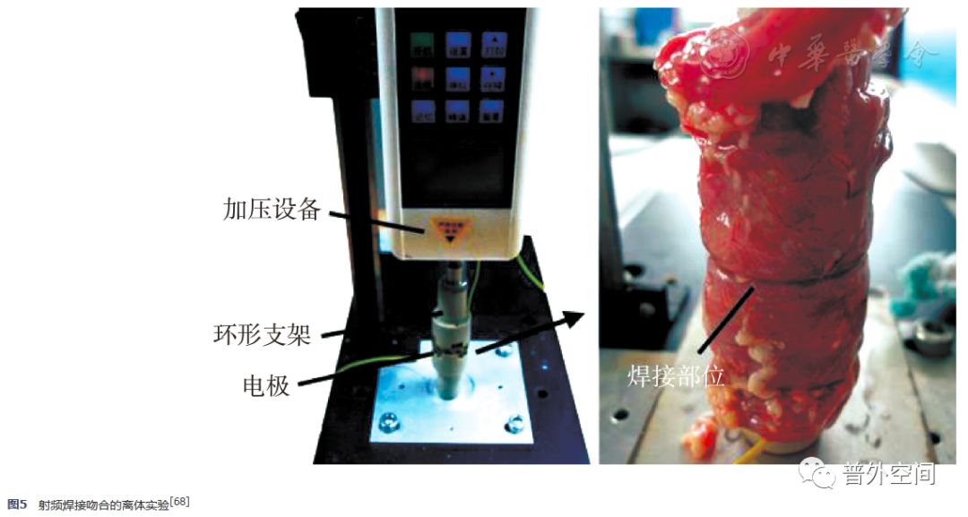 结直肠吻合器原理图,经腹腔行直肠切除吻合术概述