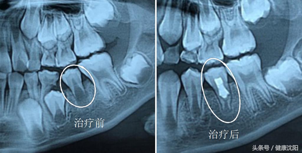 健康科普牙科,健康科普口腔科普