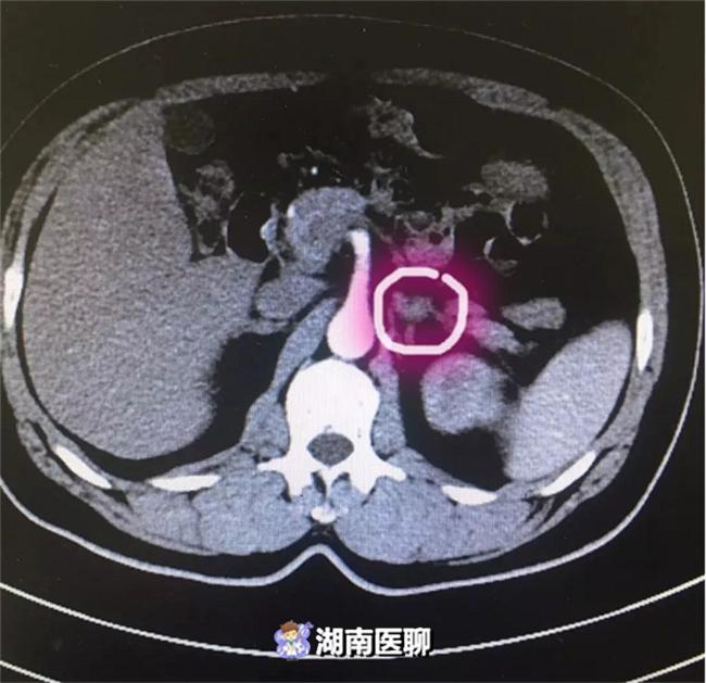 肾上腺肿瘤高血压,肾上腺肿瘤导致高血压怎么处理