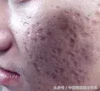 疮疤里有洞怎么修复,疮痈留下的疤能治吗