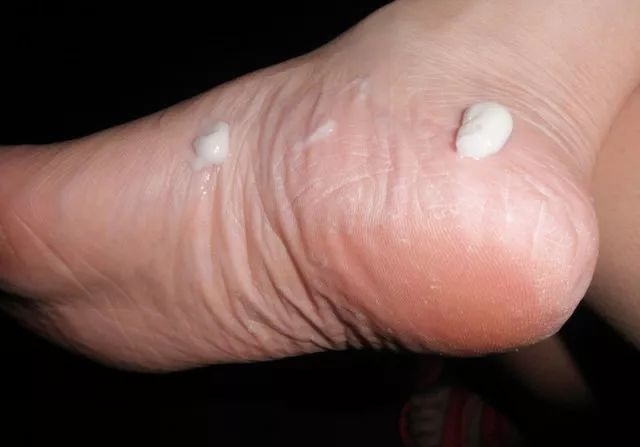 告别“香港脚”，需要用马油！一天涂抹一次，保证24小时清爽！