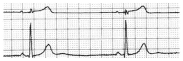 穿刺股动脉并发症,穿刺部位并发症预防及处理