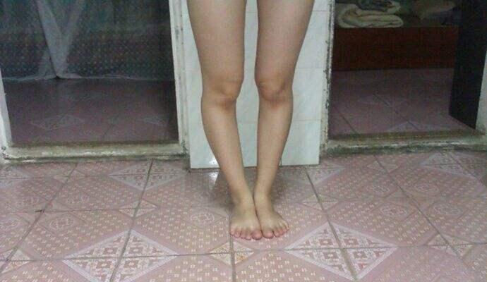 o型腿与骨盆前倾有关系吗,骨盆前倾o型腿先矫正什么