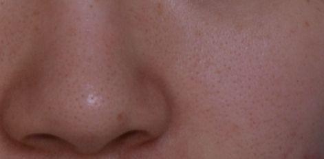 毛孔粗大如何治疗最好最快,如何治疗黑头和毛孔粗大