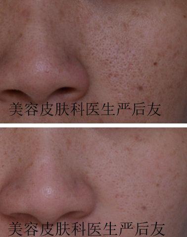 治疗毛孔粗大,激光治疗毛孔粗大多少钱