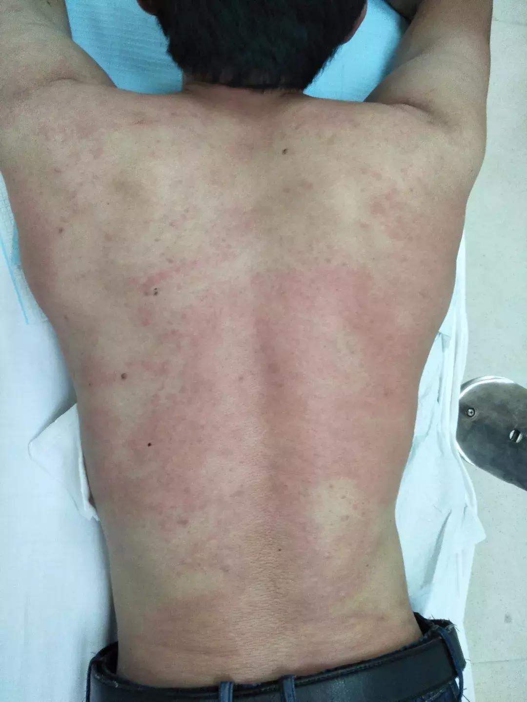 被蜜蜂或者马蜂蛰伤后的处理方式,外出游玩被毒蜂子蛰了急救措施