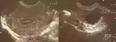 卵泡11mm子宫内膜厚度8mm,子宫内膜厚度和卵泡大小有关系吗