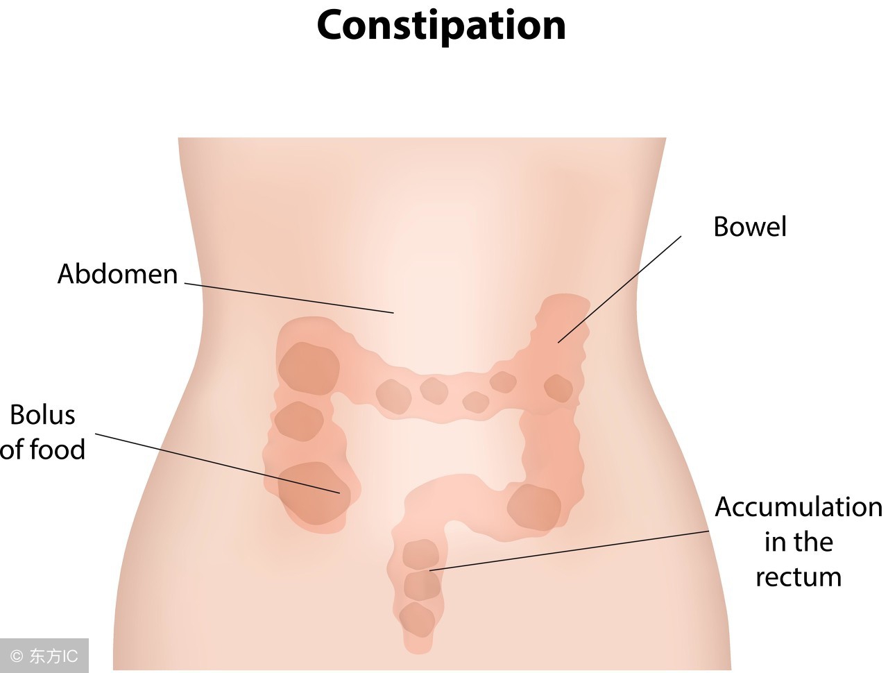 肠道大便排不干净怎么回事,肠道大便堆积拉不出来肚子疼