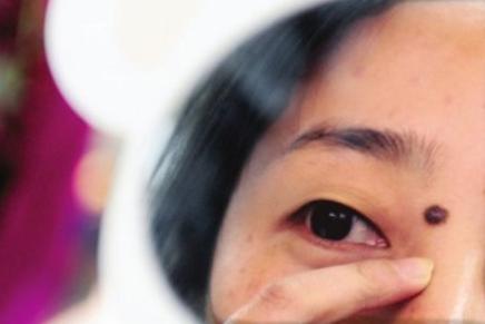 小女孩脸上的痣什么时候去掉好,脸上痣掉了留下的红疤怎么去掉