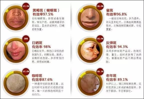 一分钟自测斑型,如何辨别自己属于哪类斑