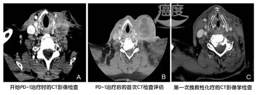 pd-1与其他化疗药可以同用吗,pd1耐药后化疗再次耐药