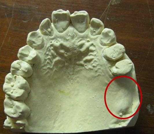 镶牙和种牙的区别种植牙的危害,种植牙的利与弊能镶牙就不要种牙