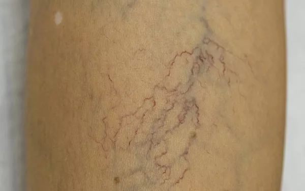 跷二郎腿有什么危害腿粗,跷二郎腿有什么危害图片