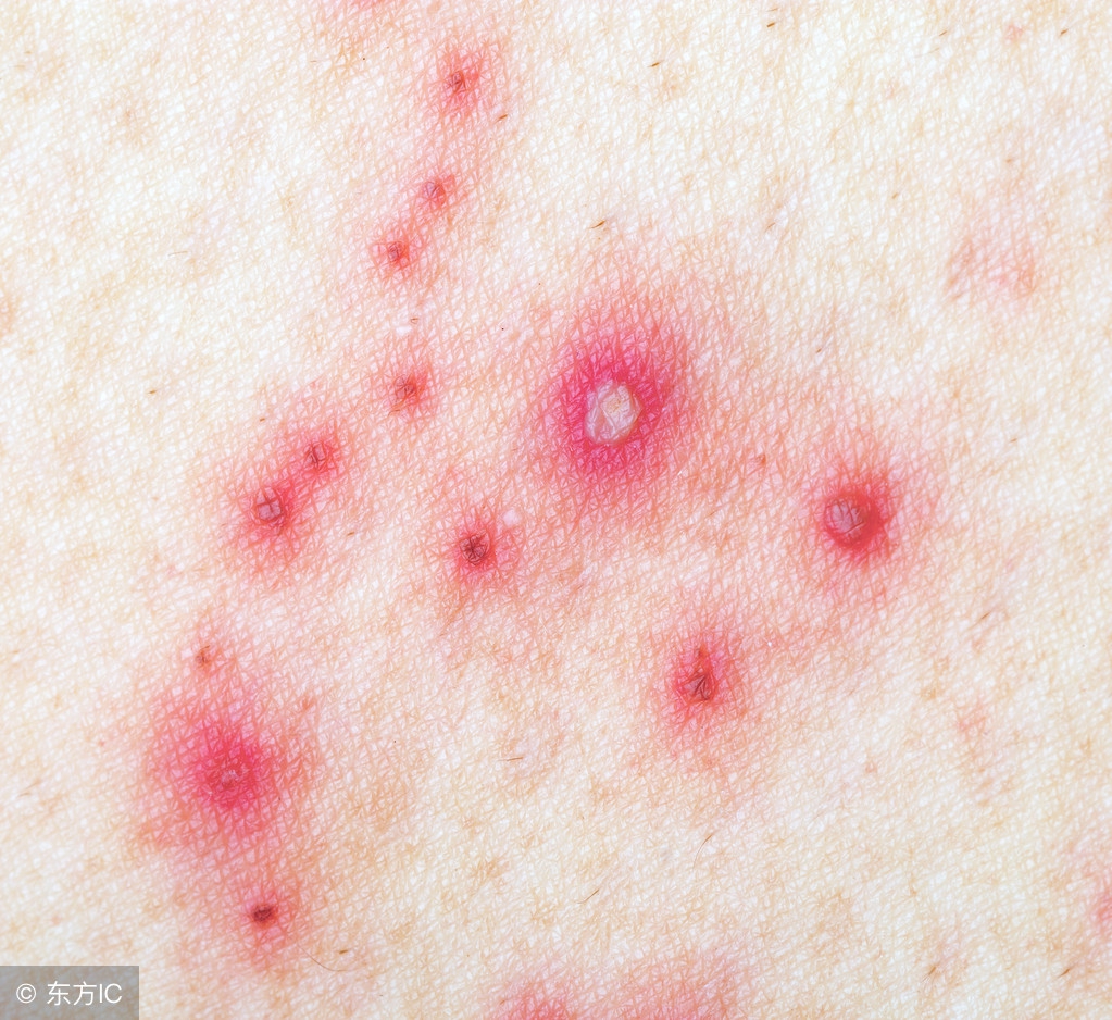 什么是生殖器疱疹与病毒感染有关吗？