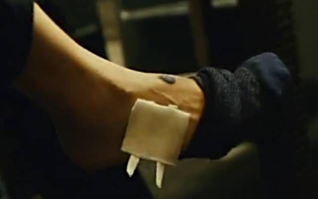 郭军黑色素瘤治愈案例,pd1抑制剂治疗黑色素瘤如何