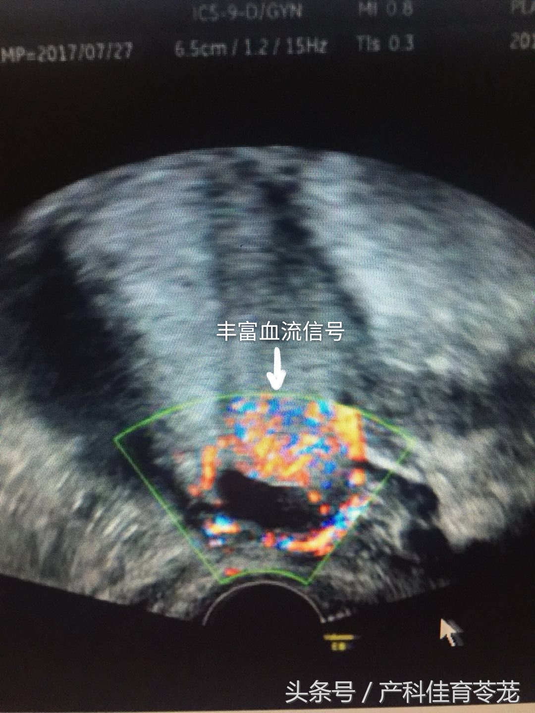 剖宫产横向瘢痕妊娠概率,怀孕7周异位妊娠瘢痕子宫