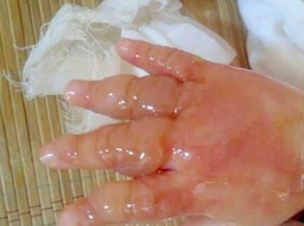 婴儿被100度烫伤怎么办,宝宝如果烫伤引起发烧该怎么办