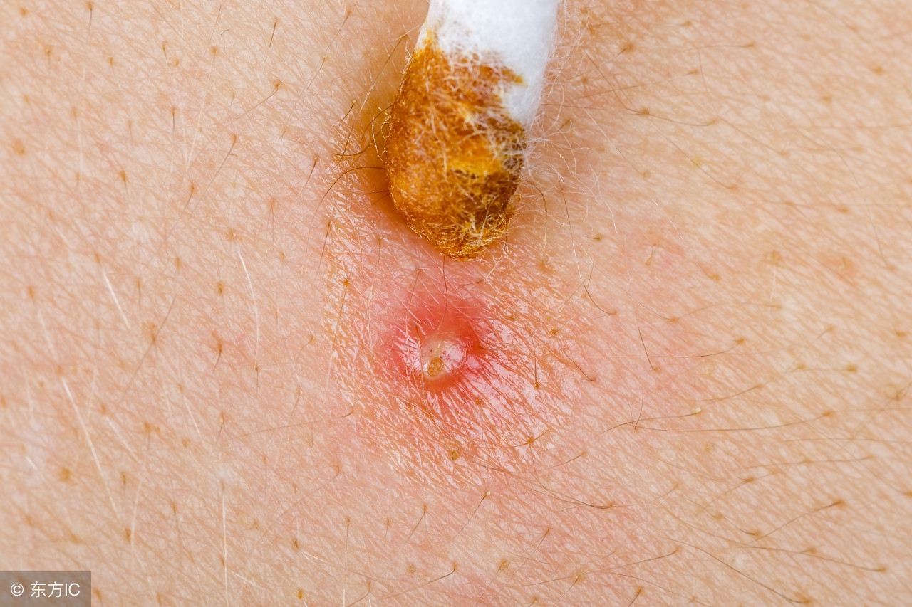 毛囊炎和疮的区别,毛囊炎是疮疖类皮肤病吗