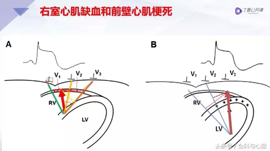 一文读懂心血管疾病,左室心梗和右室心梗