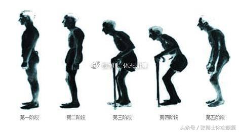 强直性脊柱炎有没有可能完全康复,强直性脊柱炎髋关节粘连康复训练