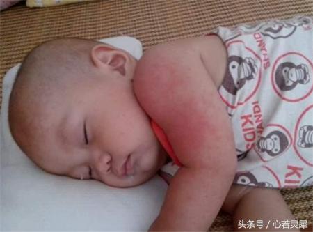 宝宝到夏天长痱子怎么办,宝宝夏季容易长痱子怎么办