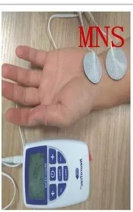 植物人促醒脊髓电刺激承受不住,植物人唤醒