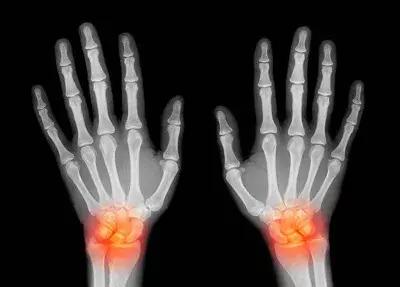 手麻痛不灵活，当心神经损伤！发现得越早，恢复得越好！