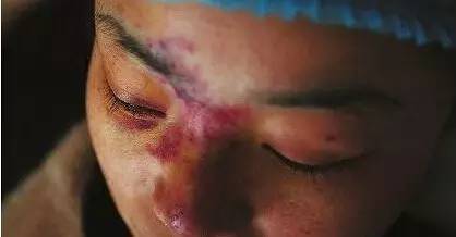 有人劝你打玻尿酸,打玻尿酸的一些常识问题