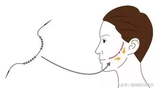 埋线提升多久能恢复好,真相来了拉皮手术潜在的风险