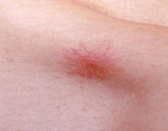 身上红痣怎么治疗,身上长红痣什么原因