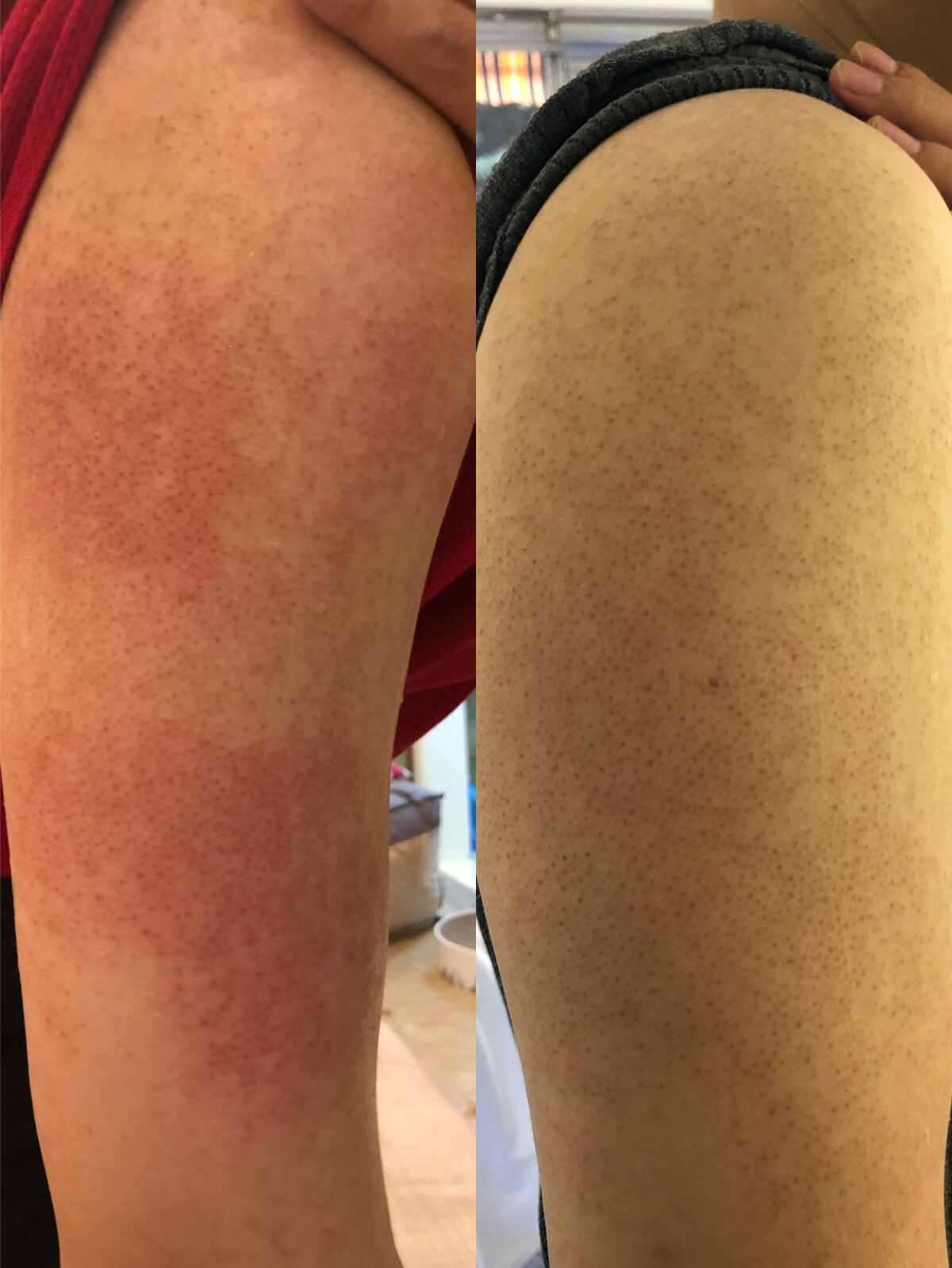 Roes教父Skr……鸡皮肤（毛周角化症）下集