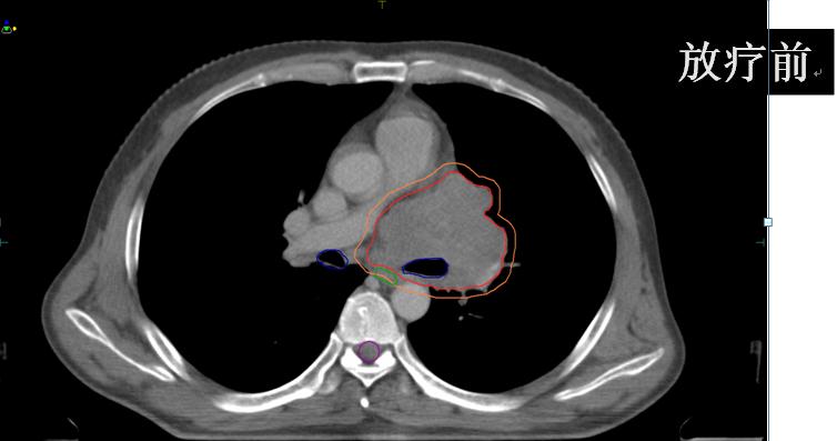 安罗替尼治小细胞肺癌吗,卡瑞利珠能治小细胞肺癌吗