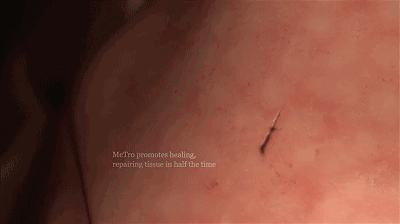 伤口愈合擦什么药膏不会留疤,伤口怎么正确处理不留疤