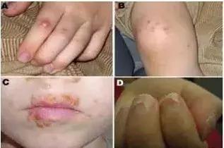 手足口病来袭如何护孩子周全,新型手足口和普通手足口